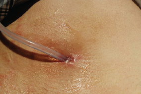 Case study: Suprapubic trial without catheter in the community